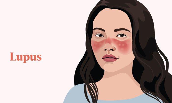 The Essential Guide to Lupus: Symptoms, Causes, Treatments, and Natural Approaches