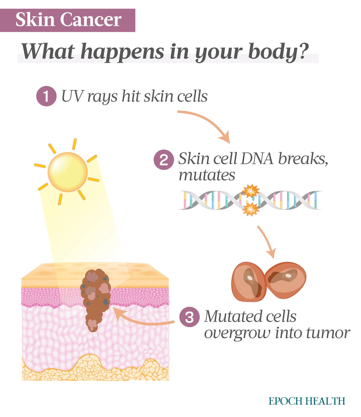 Overexposure to UV light can damage skin cell DNA, leading to an overabundance of mutated cells that may evolve into a tumor. (Illustrations from Shutterstock/Designed by The Epoch Times)