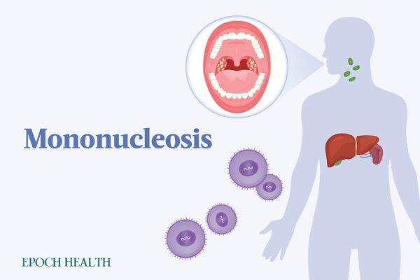 The Essential Guide to Mononucleosis: Symptoms, Causes, Treatments, and Natural Approaches