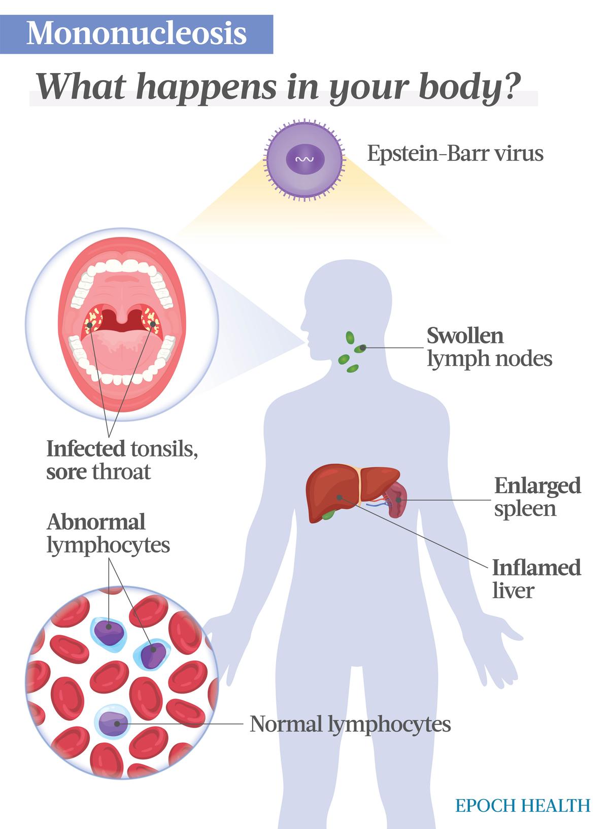 EBV enters through the throat and causes mono symptoms, including sore throat, swollen lymph nodes, an enlarged spleen, and other symptoms similar to those of the flu. (Illustrations by The Epoch Times, Shutterstock)