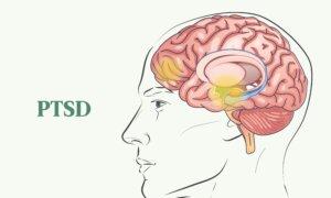 PTSD: Symptoms, Causes, Treatments, and Natural Approaches