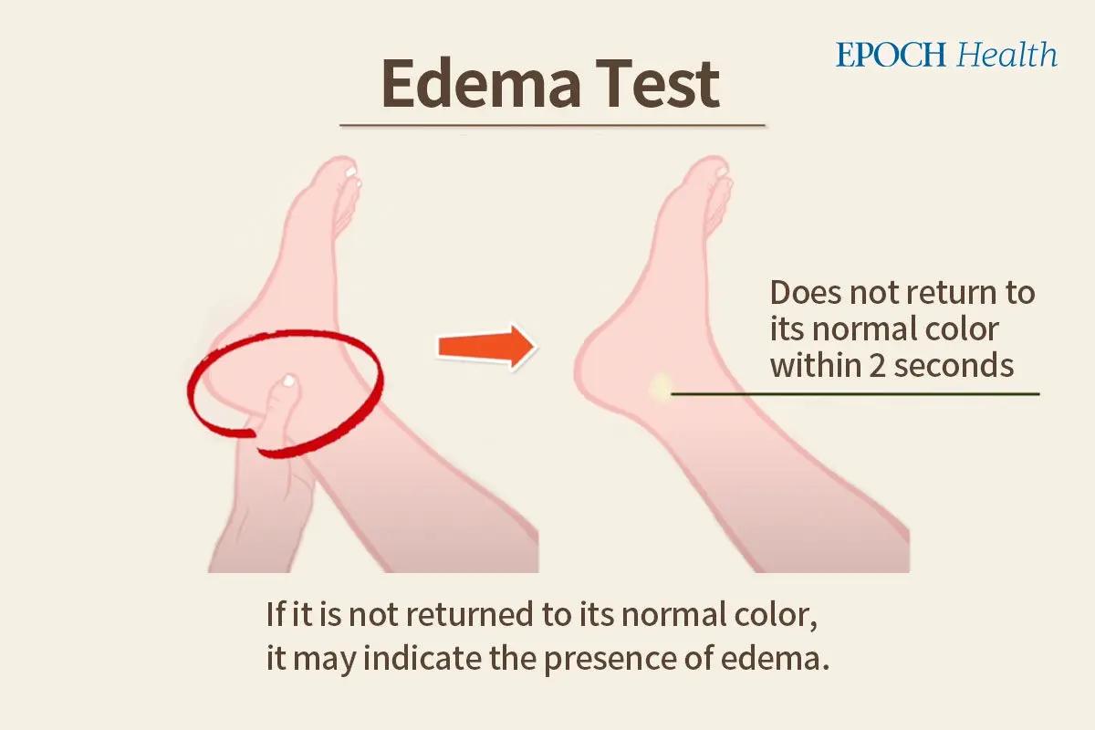 Self-examination method for edema. (The Epoch Times)