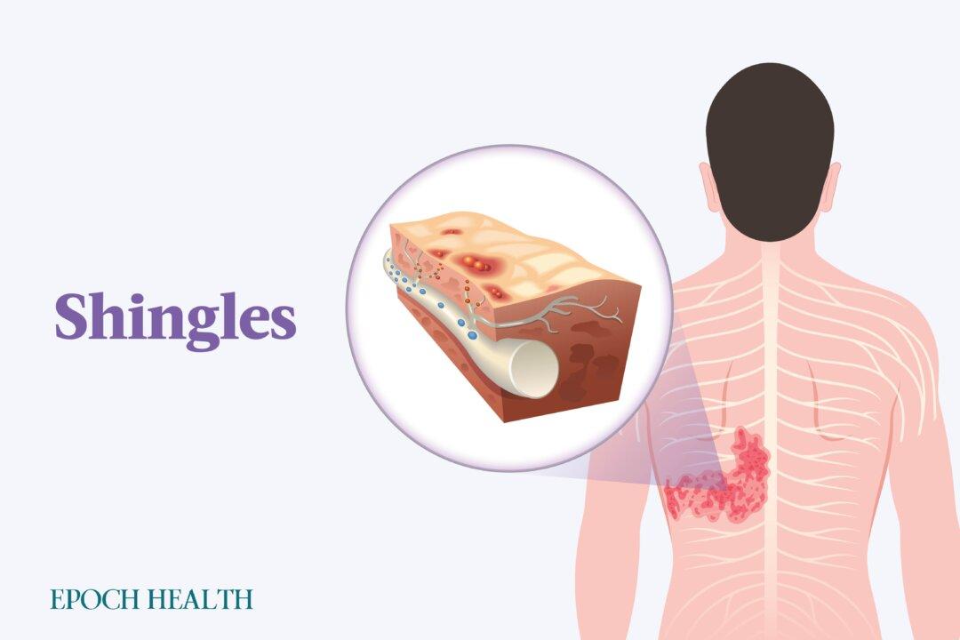 Shingles (Herpes Zoster): Symptoms, Causes, Treatments, and Natural Approaches