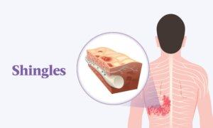 Shingles (Herpes Zoster): Symptoms, Causes, Treatments, and Natural Approaches