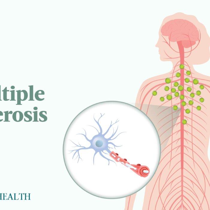 Multiple Sclerosis: Symptoms, Causes, Treatments, and Natural Approaches