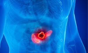 FDA Menyetujui Perawatan Baru untuk Kanker Pankreas Metastatik