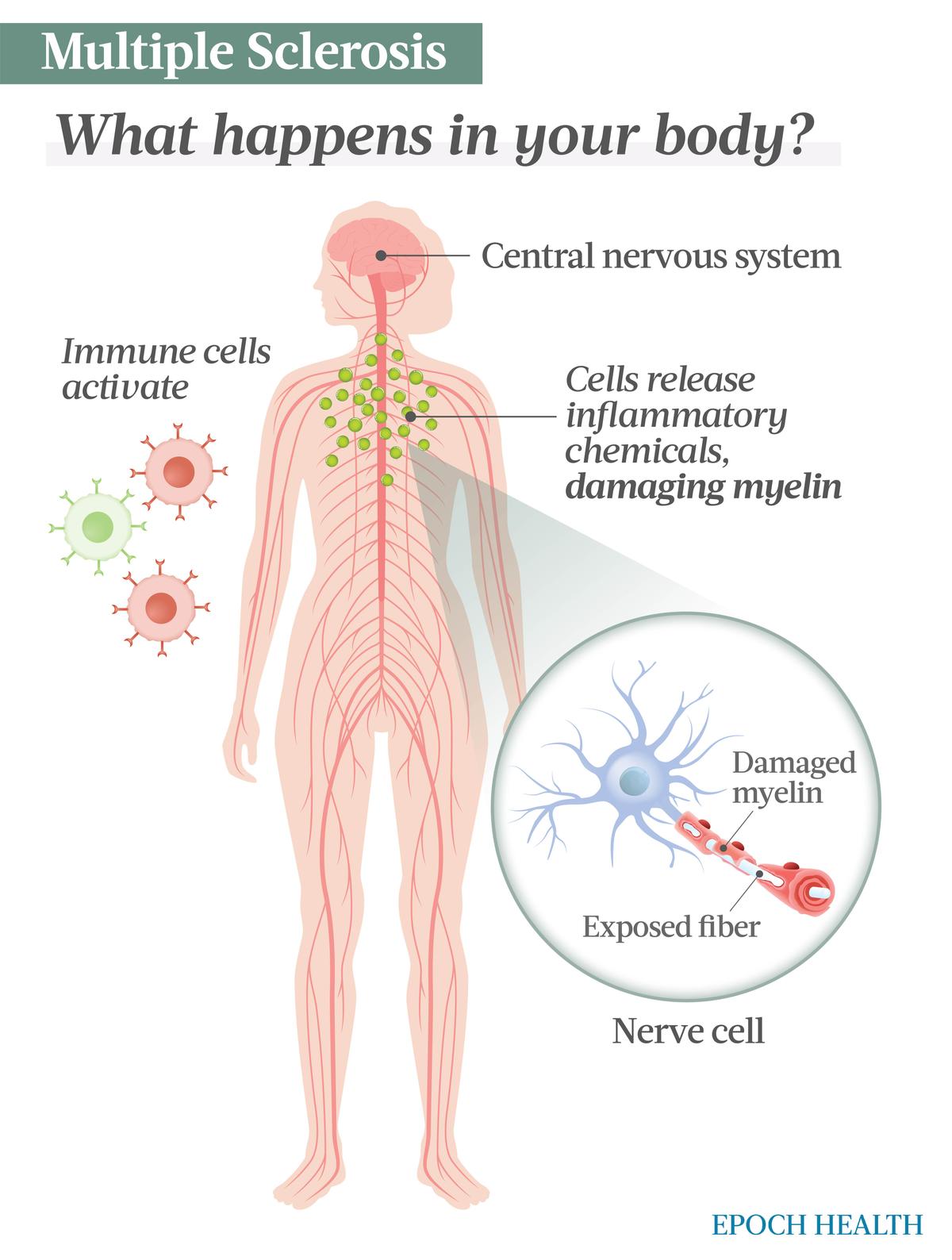 Nella SM, una risposta autoimmune attiva le cellule immunitarie come le cellule T e B, che poi rilasciano citochine infiammatorie che danneggiano la mielina, la guaina protettiva che riveste le fibre delle cellule nervose.  Ciò interrompe la comunicazione tra i nervi.  (Illustrazioni di The Epoch Times, Shutterstock)