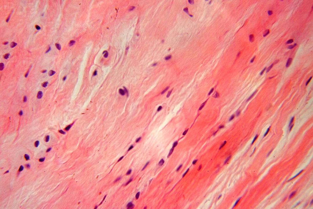 FDA Approves First Treatment for Painful Non-Cancerous Tumors