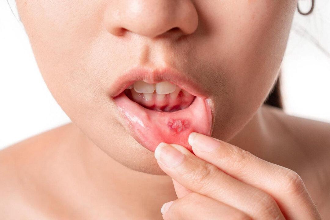 Help Heal Mouth Sores Faster With These 6 Tips