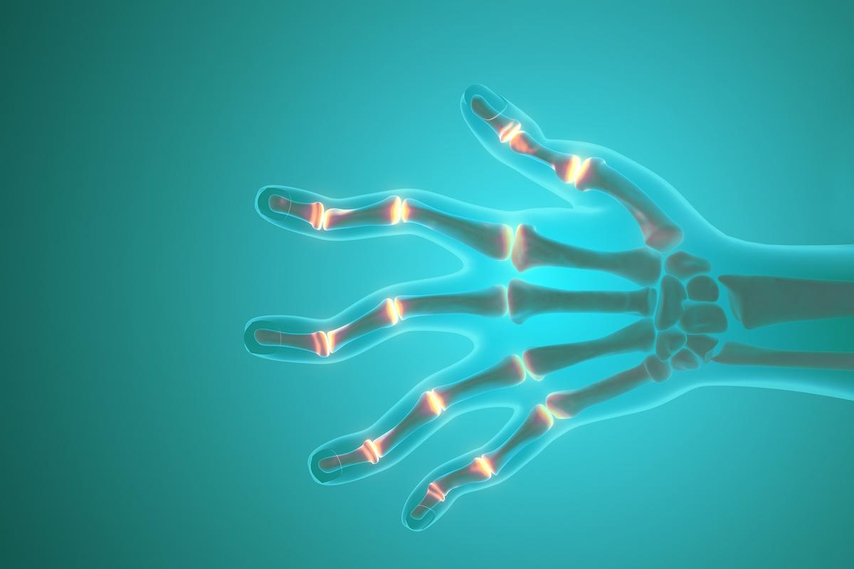 5 Therapist-Recommended Exercises to Manage Rheumatoid Arthritis