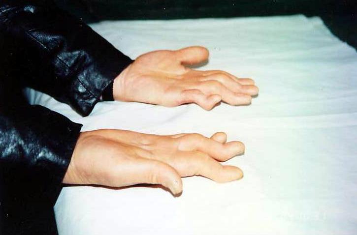 A Falun Gong adherent’s hands became disabled after being suspended by rope for extended periods. (Courtesy of Minghui.org)