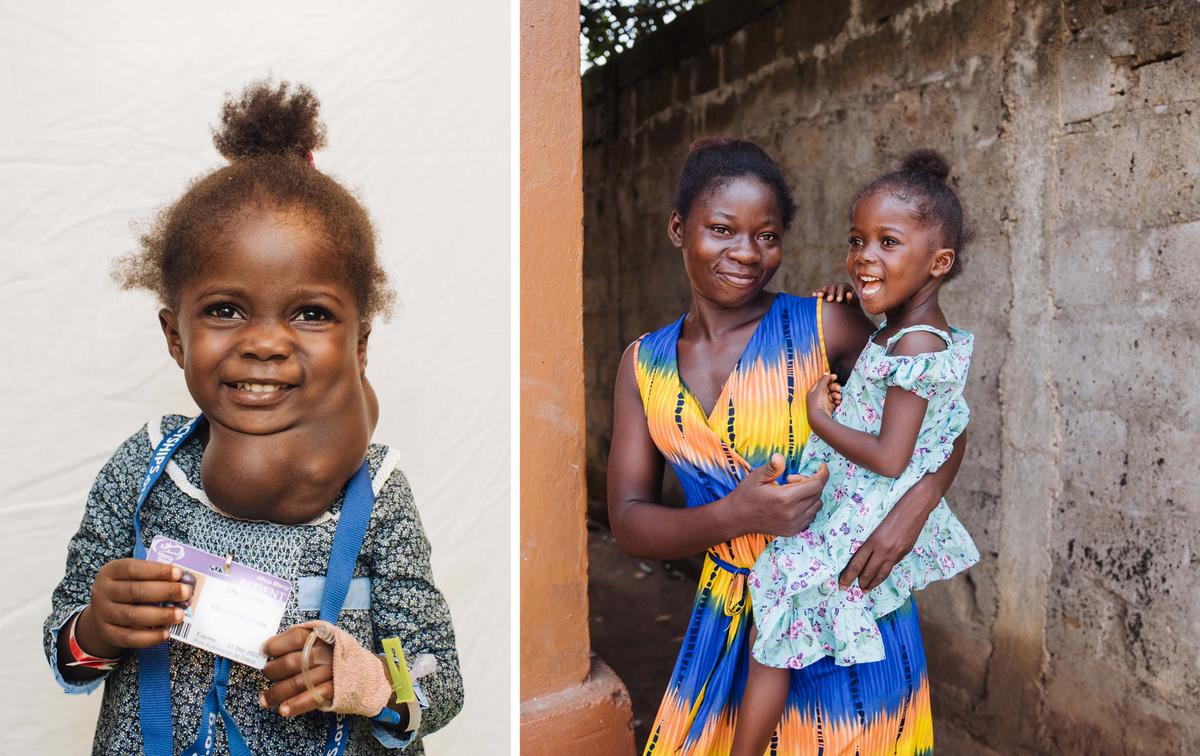 Umu before and after surgery with her mother, Yei. (SWNS)