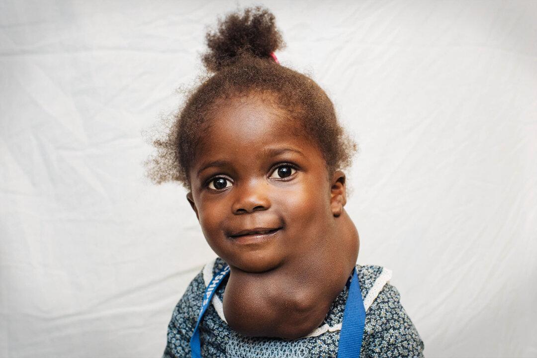Toddler Was Born With Face-Sized Mass Growing on Her Neck Suffocating Her—Until Surgeon Saves Her