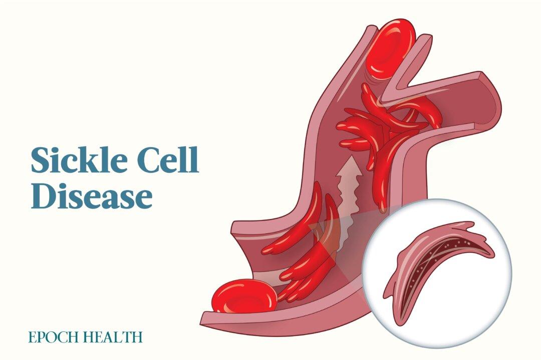 Sickle Cell Disease: Symptoms, Causes, Treatments, and Natural Approaches