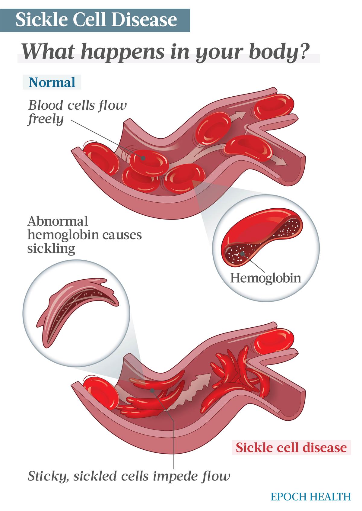 A genetic mutation in red blood cells’ hemoglobin causes them to be sickle-shaped and sticky, which makes them clump together and impede blow flow. (Illustrations by The Epoch Times, Shutterstock)