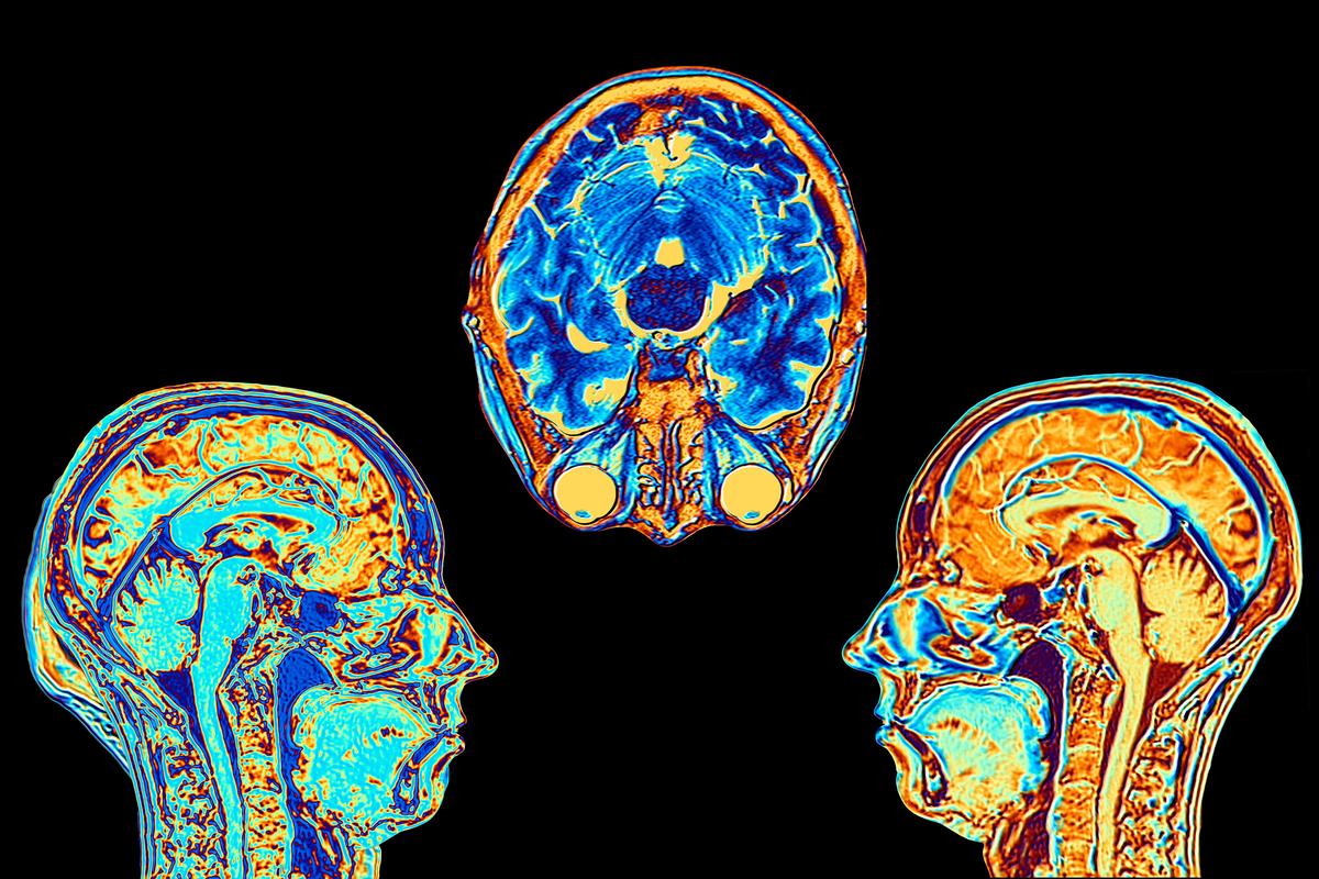 Global Cancer Cases to Jump 77 Percent to 35 Million in 2050: Study