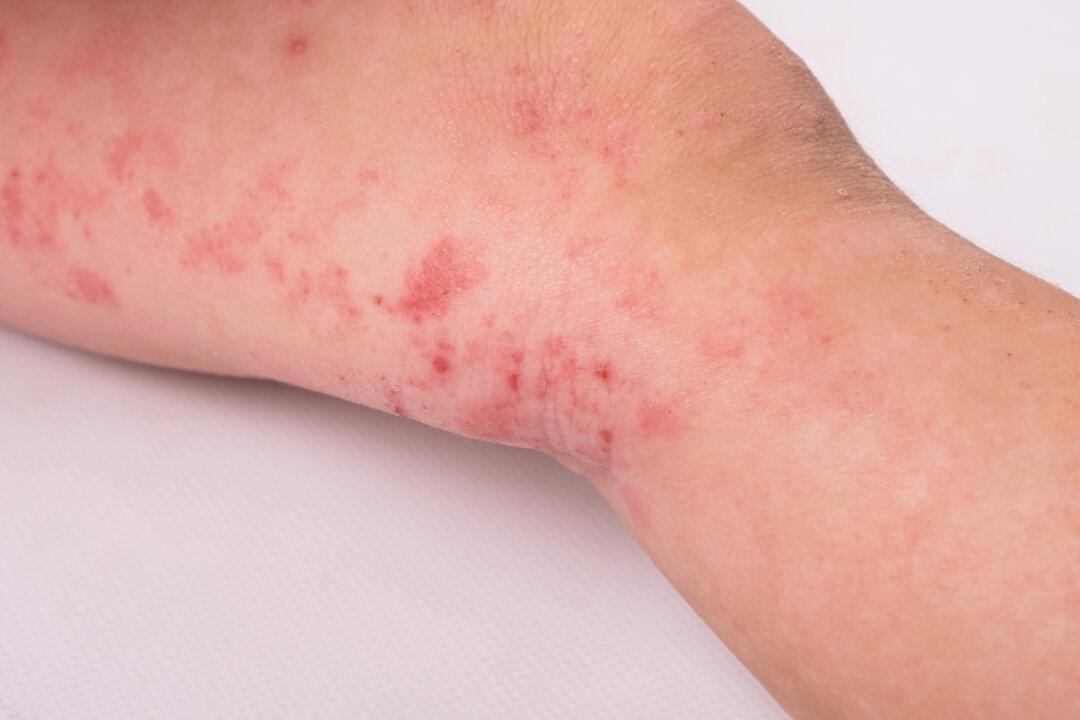 Link Between the Gut and Skin Is Key Factor in Eczema: Report