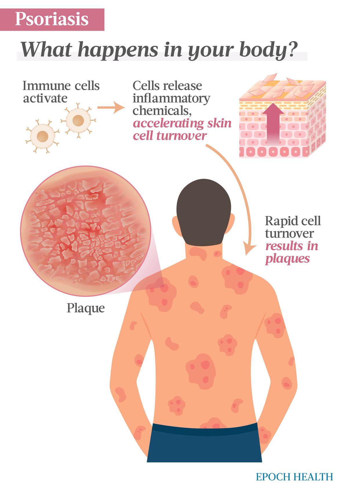 In this autoimmune condition, activated immune cells release cytokines that prompt skin cells to turn over more rapidly than usual. Instead of turning over in weeks, cells turn over in days, accumulating scaly plaques on the skin’s surface. (Illustrations by The Epoch Times, Shutterstock)