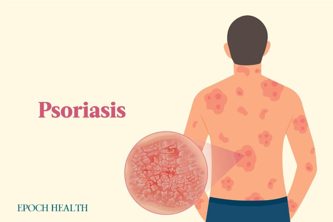 Psoriasis: Symptoms, Causes, Treatments, and Natural Approaches