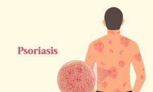Psoriasis: Symptoms, Causes, Treatments, and Natural Approaches