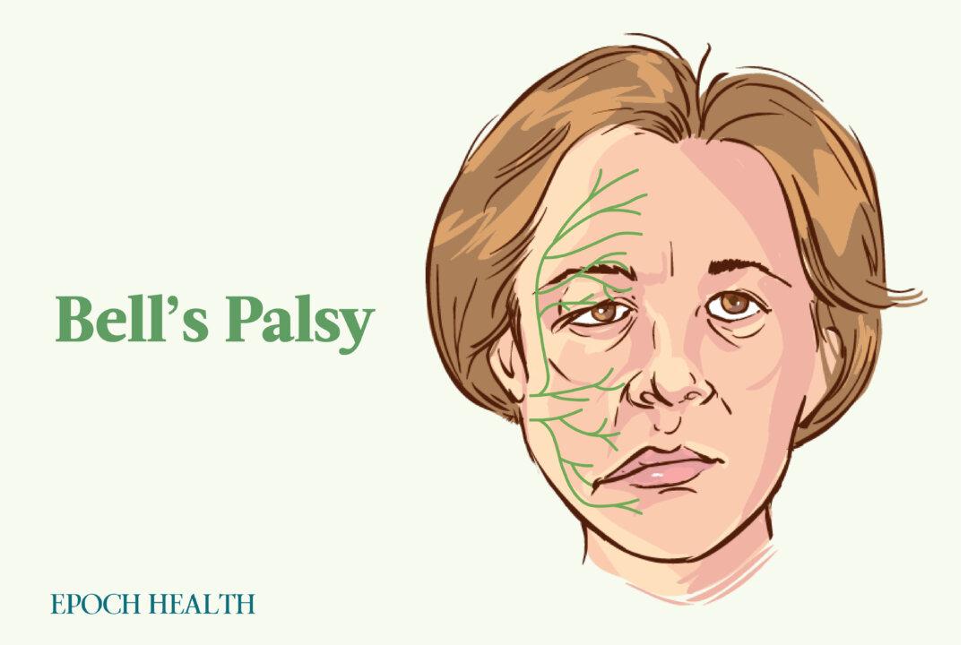 The Essential Guide to Bell’s Palsy: Symptoms, Causes, Treatments, and Natural Approaches