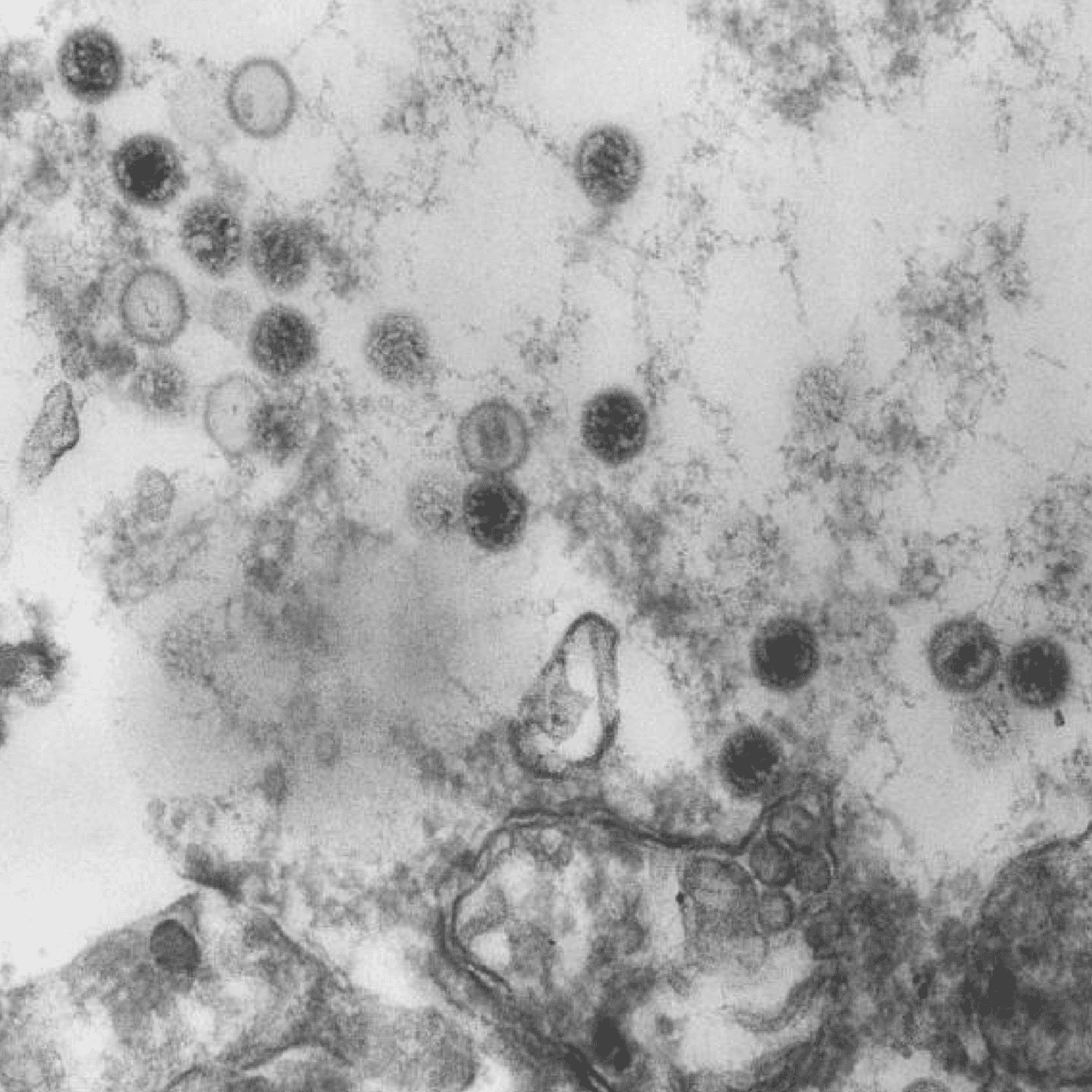 The Epstein-Barr virus particles in an undated image from an electron microscope. (Courtesy of the CDC)