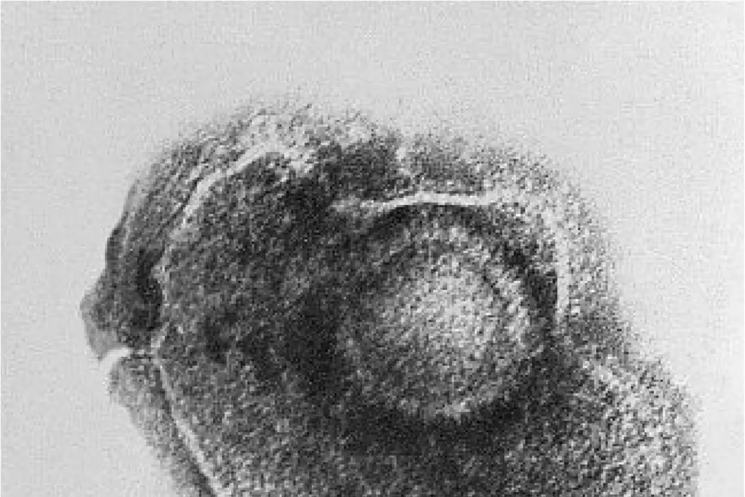 Chickenpox: A Childhood Illness in a Different Era