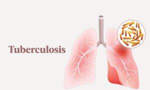 Tuberculosis: Symptoms, Causes, Treatments, and Natural Approaches