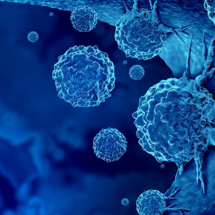 Advanced Prostate Cancer Cases on the Rise After Years of Decline: What You Need to Know