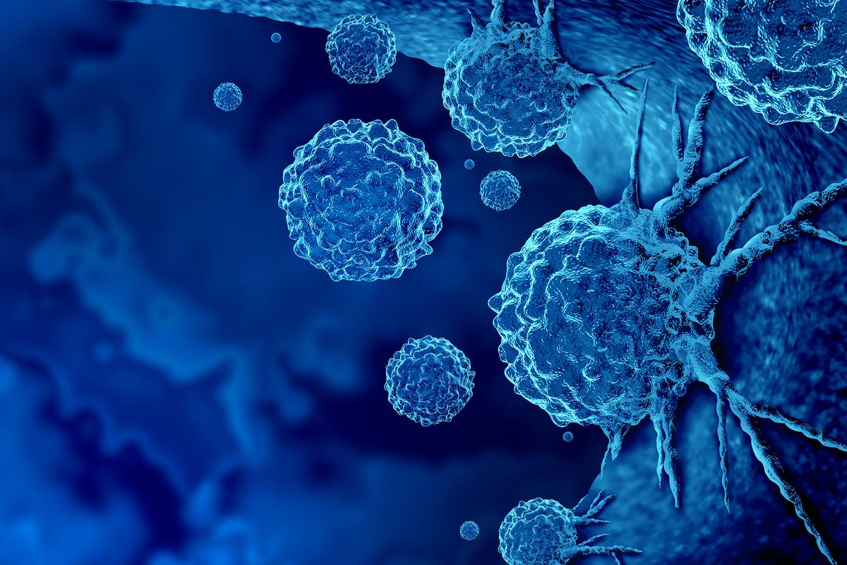 Advanced Prostate Cancer Cases on the Rise After Years of Decline: What You Need to Know