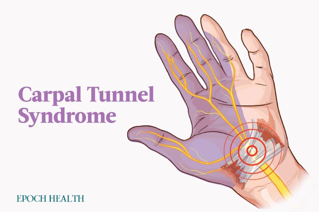 Carpal Tunnel Syndrome: Symptoms, Causes, Treatments, and Natural Approaches