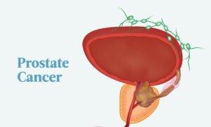 Prostate Cancer: Symptoms, Causes, Treatments, and Natural Approaches