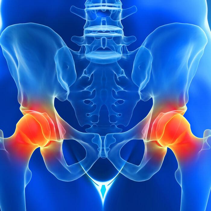 Suddenly Arthritic: 6 Key Exercises to Help Counter Reactive Arthritis