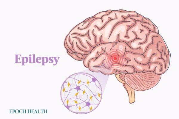 The Essential Guide to Epilepsy: Symptoms, Causes, Treatments, and Natural Approaches