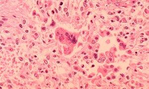 Measles Cases Spread at South Florida Elementary School