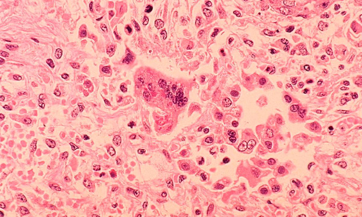 A 1972 photo shows a microscopic image of the measles virus. (Dr. Edwin P. Ewing, Jr./CDC)
