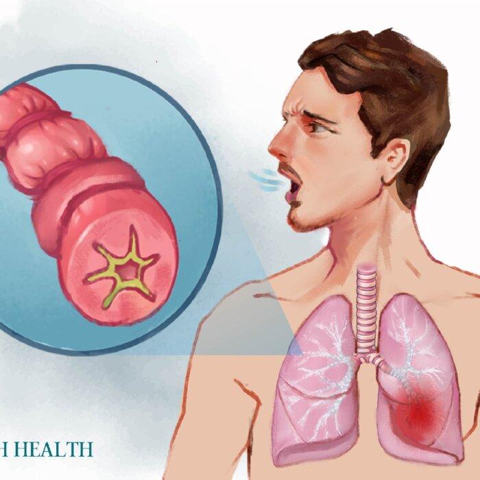 The Essential Guide to Asthma: Symptoms, Causes, Treatments, and Natural Approaches