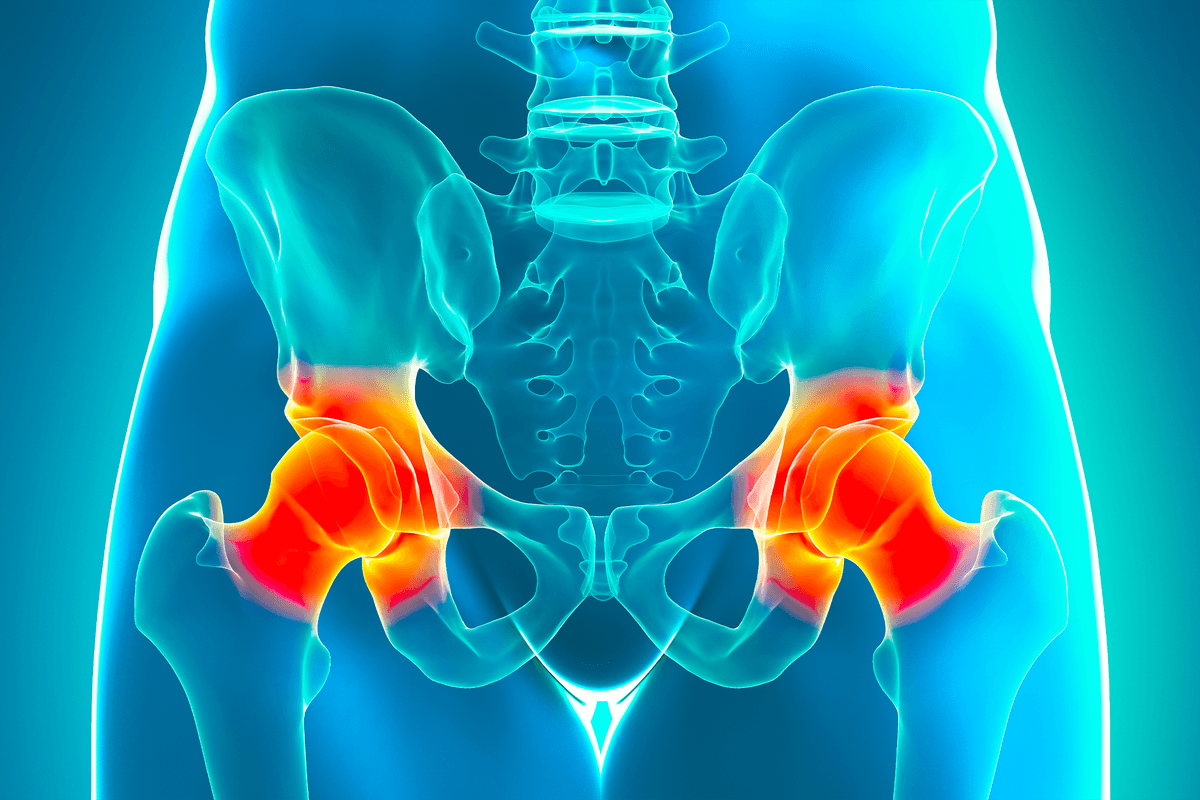 Suddenly Arthritic: 6 Key Exercises to Help Counter Reactive Arthritis