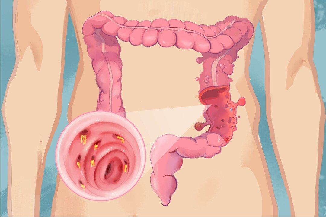 Diverticulitis: Symptoms, Causes, Treatments, and Natural Approaches