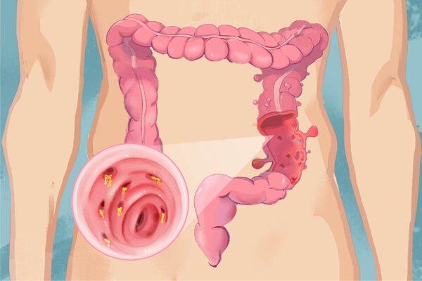 The Essential Guide to Diverticulitis: Symptoms, Causes, Treatments, and Natural Approaches