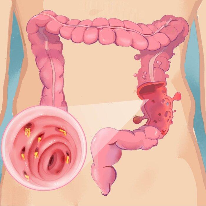 Diverticulitis: Symptoms, Causes, Treatments, and Natural Approaches