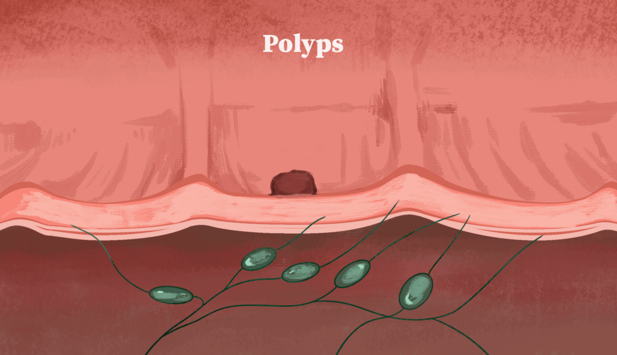 How colorectal cancer develops from polyps. (Illustration by The Epoch Times)