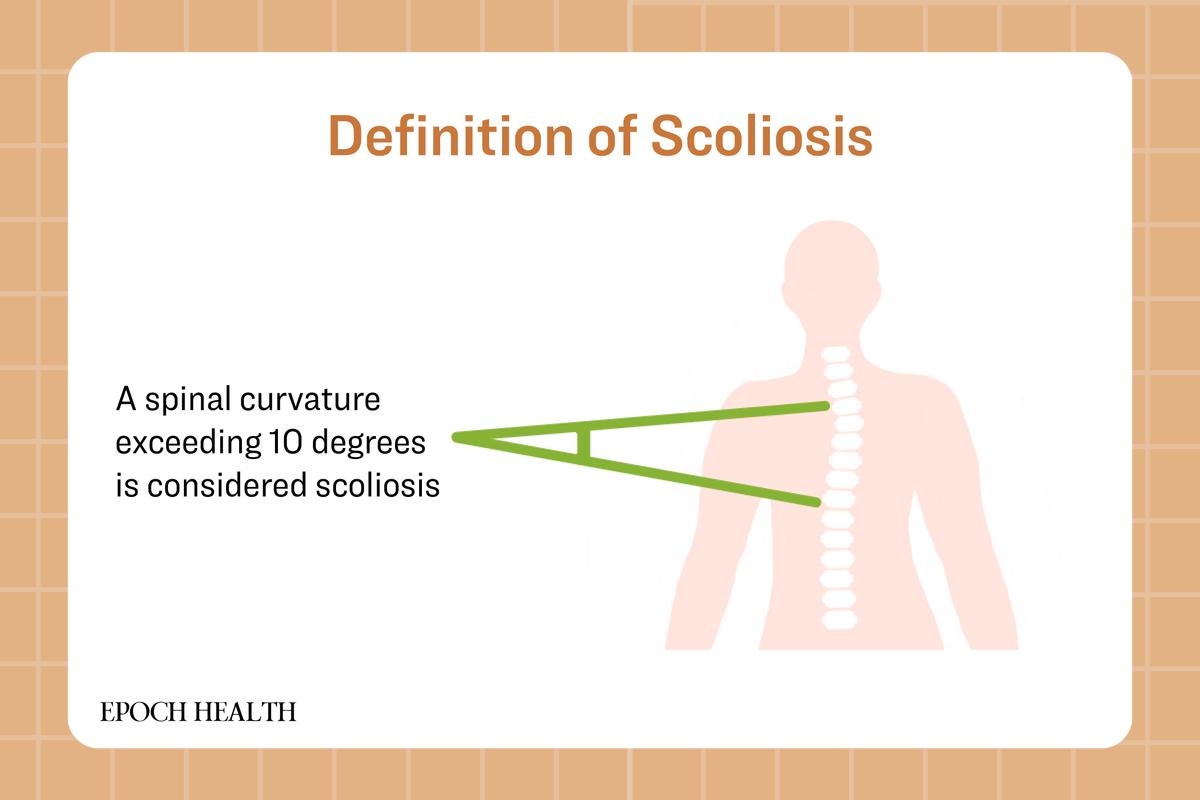 A spinal curvature exceeding 10 degrees to the side is diagnosed as scoliosis. (The Epoch Times)