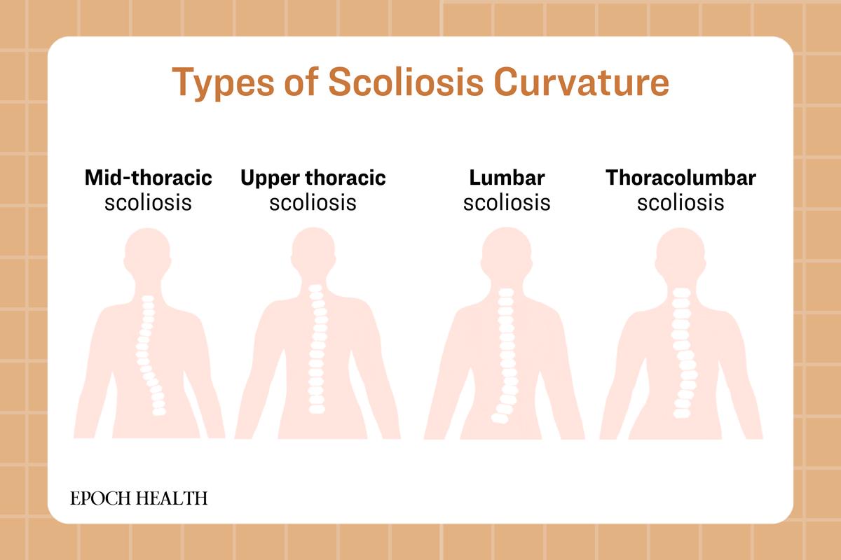 The major types of scoliosis curvature. (The Epoch Times)