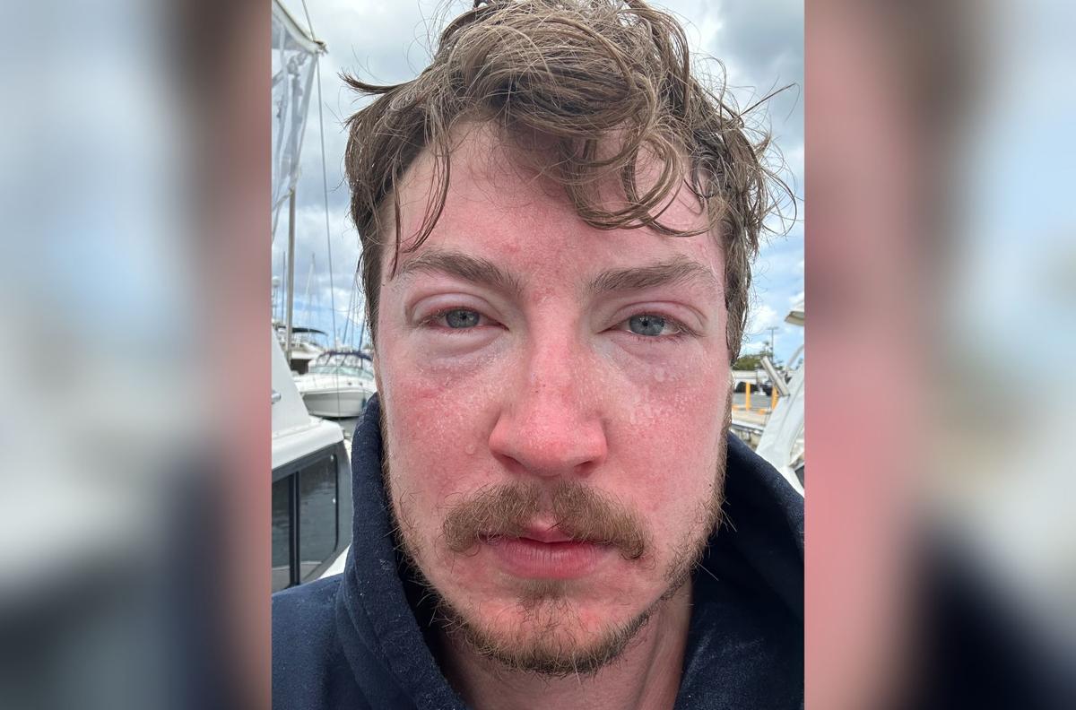 ‘Like a Hot Iron.’ BC Man’s Ultra-Marathon Hawaiian Swim Is Scuttled by Jellyfish