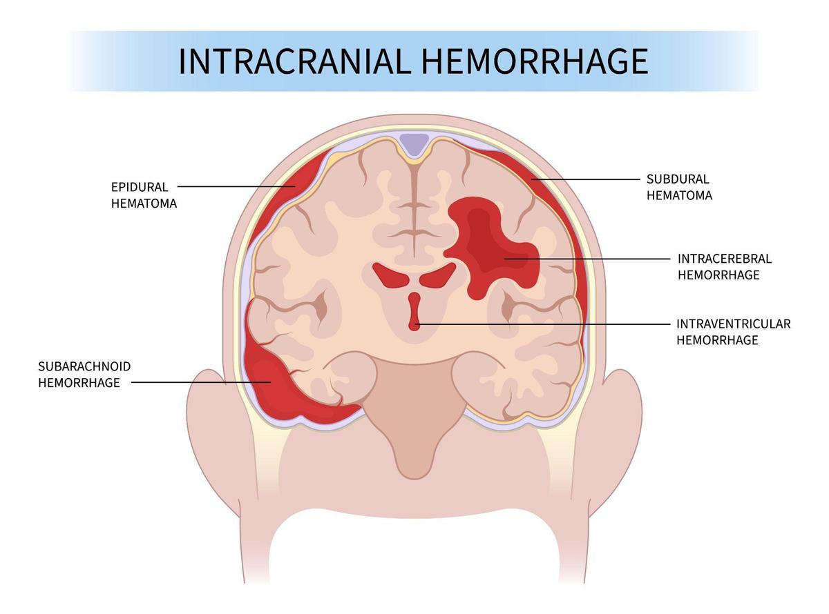 Acute Subdural Hematoma: 5 High-Risk Groups Identified by Experts | USNN World News (Pepermpron/Shutterstock)