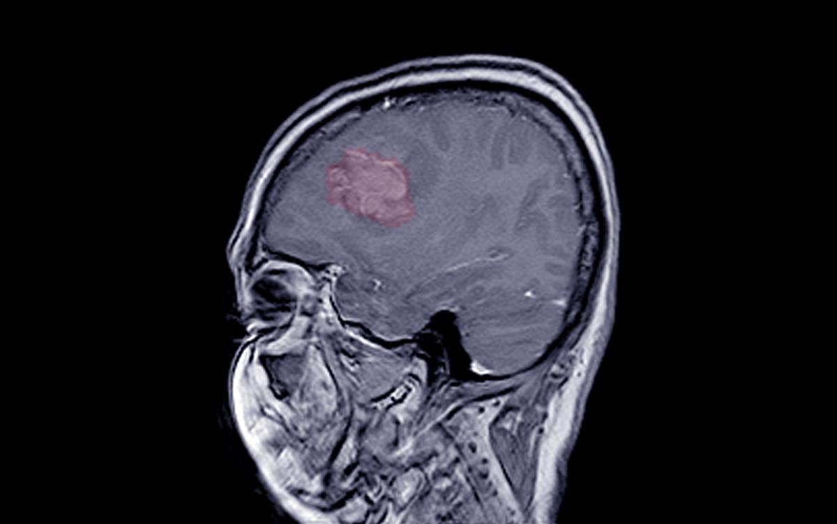 Certain Progestogens Linked to Higher Risk of Brain Tumors, Study Finds