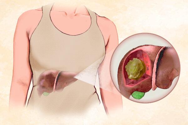 Liver Cancer: Symptoms, Causes, Treatments, and Natural Approaches