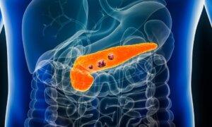 Tanda-Tanda Awal Potensi Kanker Pankreas: Wawasan Dari Kasus Klinis