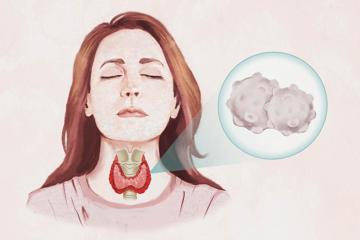 Hashimoto’s Thyroiditis: Symptoms, Causes, Treatments, and Natural Approaches